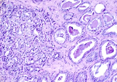 Histological slide showing cancerous prostate tissue